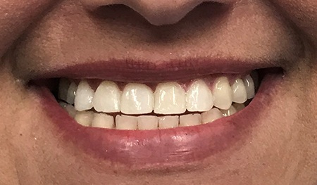 Top tooth flawlessly replaced