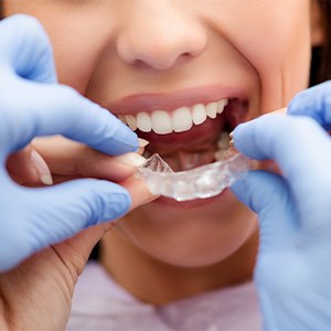 Dentist placing Invisalign tray