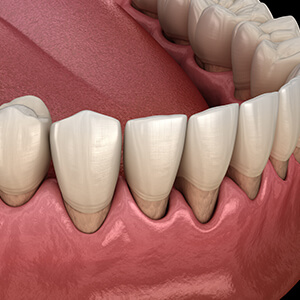 Animation of smile with severely receded gum tissue