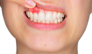 Closeup of smile with damaged gum tissue