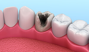 Animation of decayed tooth