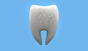 Animation of cracked tooth